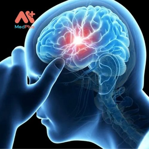Hội chứng đau nửa đầu Migraine gây ra triệu chứng đau nửa đầu bên phải hoặc trái thường gặp với tần suất như nhau