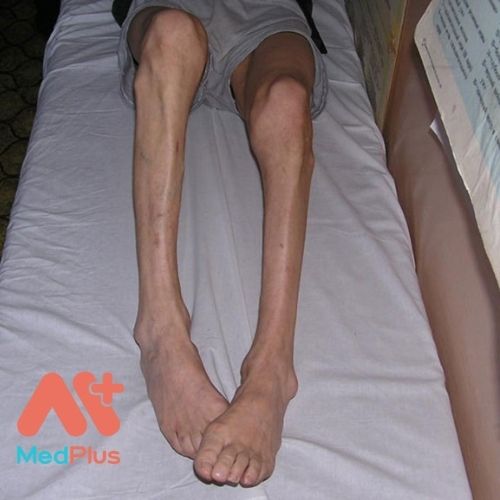 BỆNH SARCOPENIA: TRIỆU CHỨNG VÀ NGĂN NGỪA 130 Bệnh sarcopenia