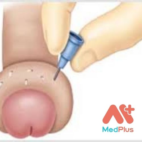 VIÊM BAO QUY ĐẦU: TRIỆU CHỨNG VÀ ĐIỀU TRỊ 130 Viêm bao quy đầu