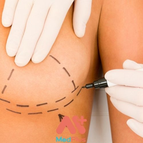 BỆNH BƯỚU SỢI TUYẾN: CÁC TRIỆU CHỨNG 129 Bệnh bướu sợi tuyến