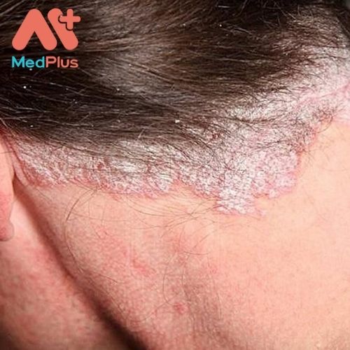 Vảy nến da đầu là một tình trạng ngoài da phổ biến.