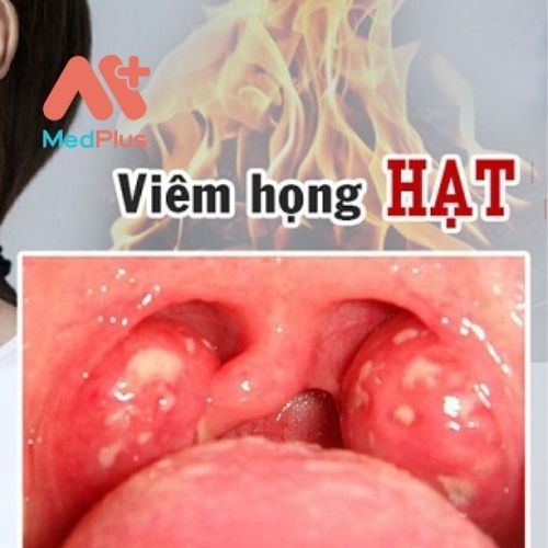 Viêm họng hạt là tình trạng viêm nhiễm mãn tính quá phát gây ra các triệu chứng viêm, đau, sưng tấy