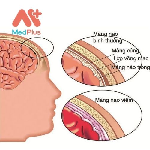 Viêm màng não là tình trạng viêm màng (màng não) bao quanh tủy sống và não của bạn.