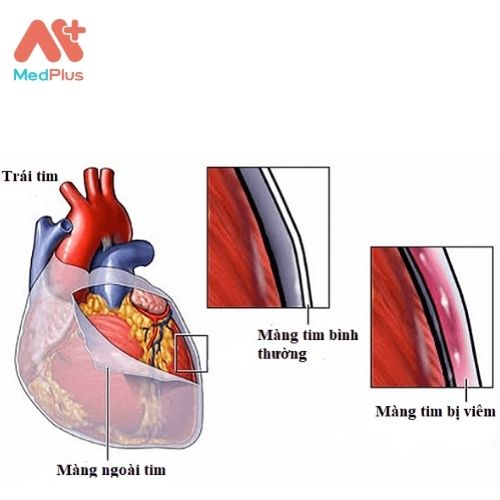 Viêm màng ngoài tim là một túi mỏng, hai lớp chứa đầy chất lỏng bao phủ bề mặt bên ngoài của tim. 