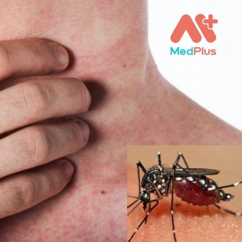 Virus Chikungunya là một bệnh do vi rút truyền sang người do muỗi Aedes bị nhiễm bệnh.