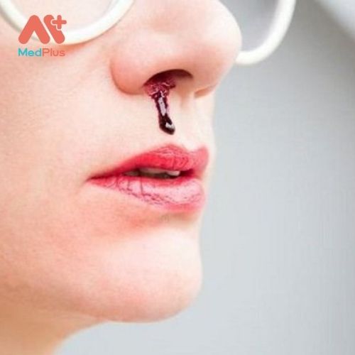 Chảy máu cam liên quan đến việc chảy máu từ bên trong mũi của bạn.