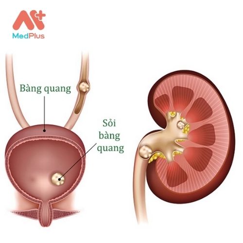 Sỏi bàng quang là những khối khoáng chất cứng trong bàng quang.