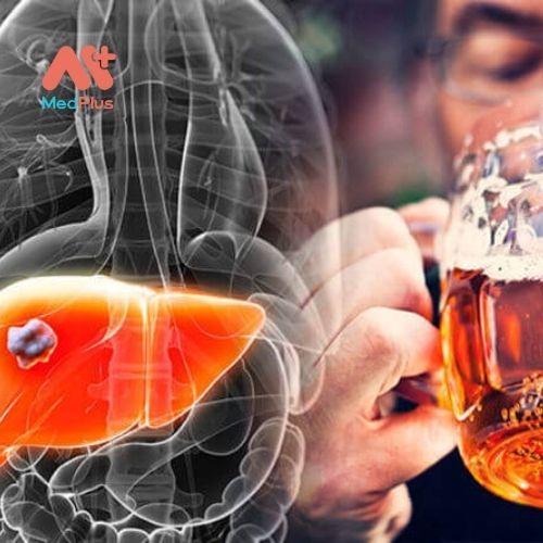 Thường xuyên uống rượu bia sẽ rất hại cho gan, có thể dẫn đến suy gan hoặc ung thư gan 