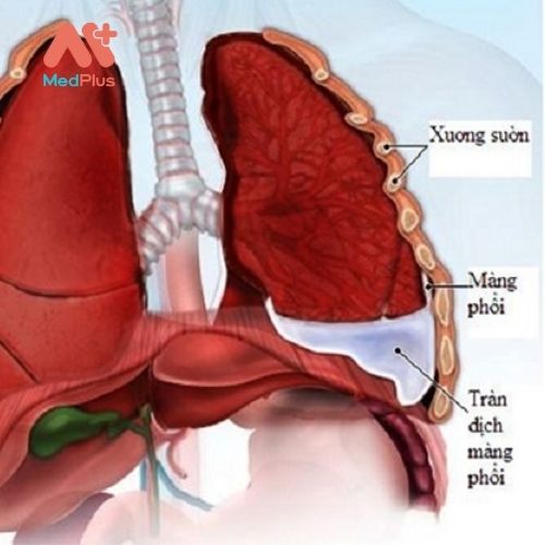 Tìm hiểu về bệnh tràn dịch màng phổi