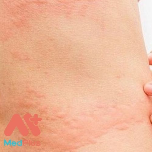 4 ĐIỀU CẦN BIẾT VỀ NHIỄM SÁN CHÓ 130 Bệnh nhiễm sán chó