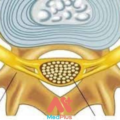 BỆNH HẸP ỐNG SỐNG: TRIỆU CHỨNG VÀ ĐIỀU TRỊ 129 Bệnh hẹp ống sống