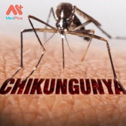 Virus Chikungunya