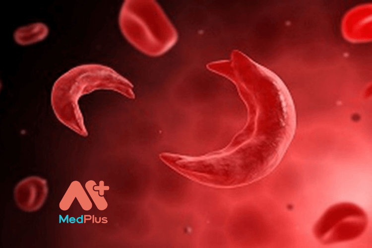 10 biến chứng nguy hiểm của bệnh hồng cầu lưỡi liềm