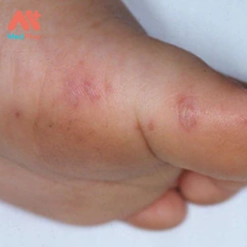 Phát ban do virus ở bàn tay, bàn chân và miệng trên bàn chân