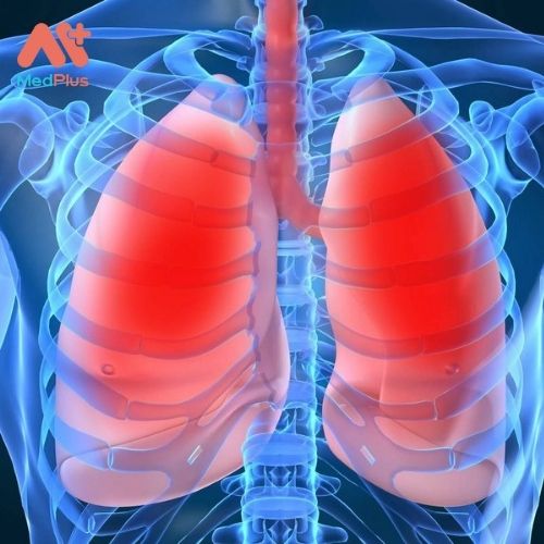 Triệu chứng của bệnh xẹp phổi