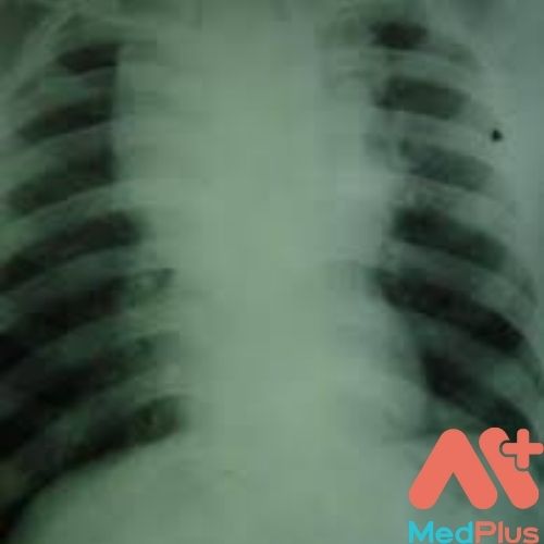 HỘI CHỨNG TRUNG THẤT CÓ TÌNH TRẠNG NHƯ THẾ NÀO? 129 Hội chứng trung thất