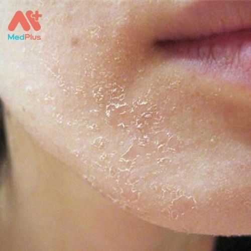 Viêm da tiết bã có những biệu hiện nào xảy ra? 128 Viêm da tiết bã gây ra các vết vảy trắng trên mặt
