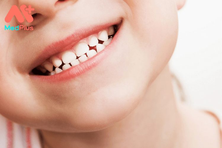 Bé bị sâu răng sữa có sao không?