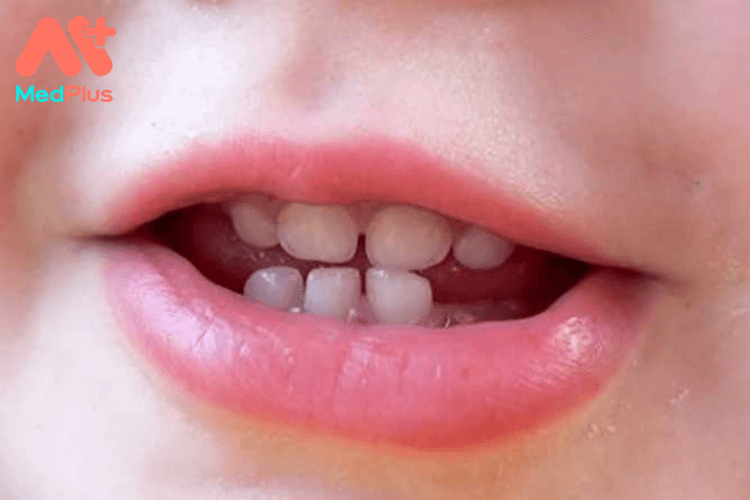 Trẻ mấy tháng mọc răng?