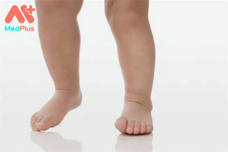 Trẻ sơ sinh bị cong chân phải làm sao?