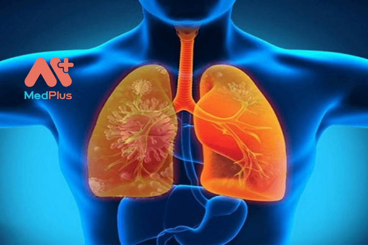 Viêm phổi hít là bệnh gì?