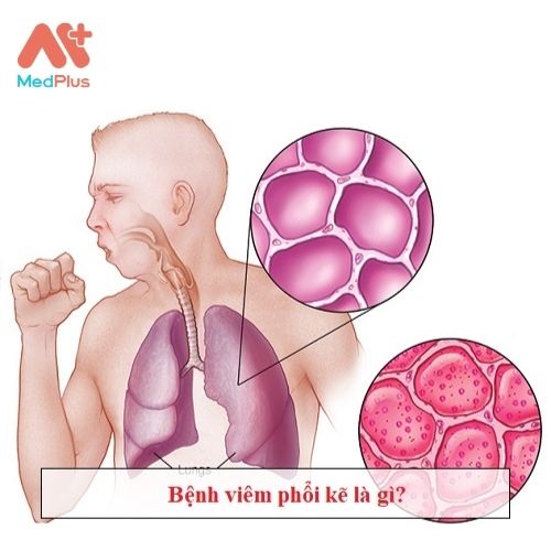 Bệnh phổi kẽ và những thông tin điều bạn cần biết. 128 Nguyên nhân gây bệnh phổi kẽ