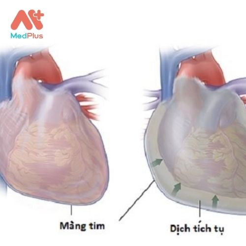 Tràn dịch màng ngoài tim