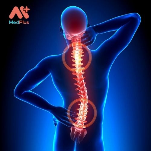 Khối u đốt sống do nguyên nhân bệnh lý nào? 135 Triệu chứng khối u đốt sống