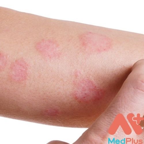 bệnh keratosis pilaris