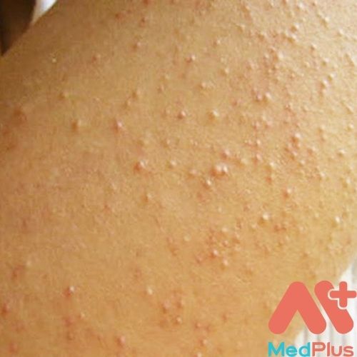 bệnh keratosis pilaris