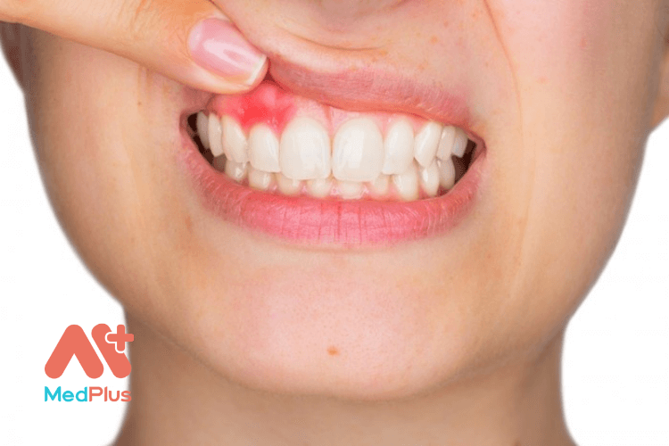 Bạn nên làm gì để giảm đau nướu răng hiệu quả?