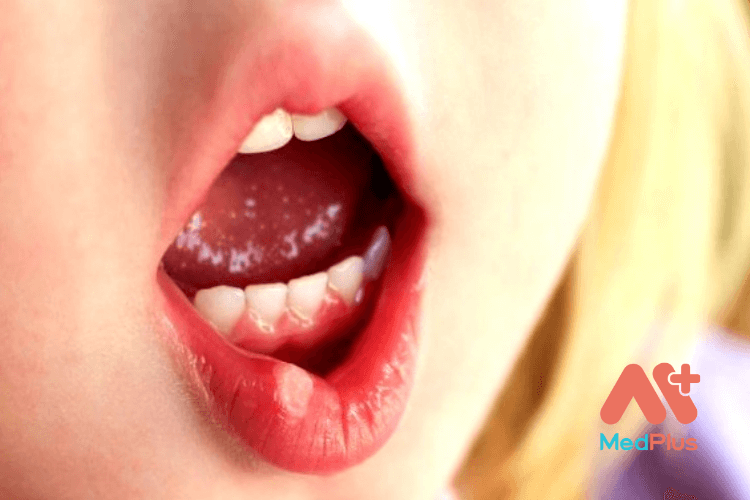 4 nguyên nhân gây nhiệt miệng và cách phòng chống nhiệt miệng hiệu quả