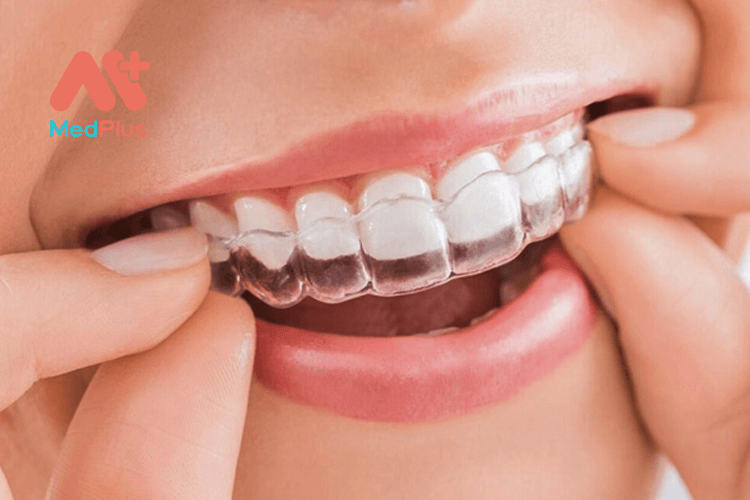 3 lý do bạn nên chọn niềng răng mắc cài trong suốt
