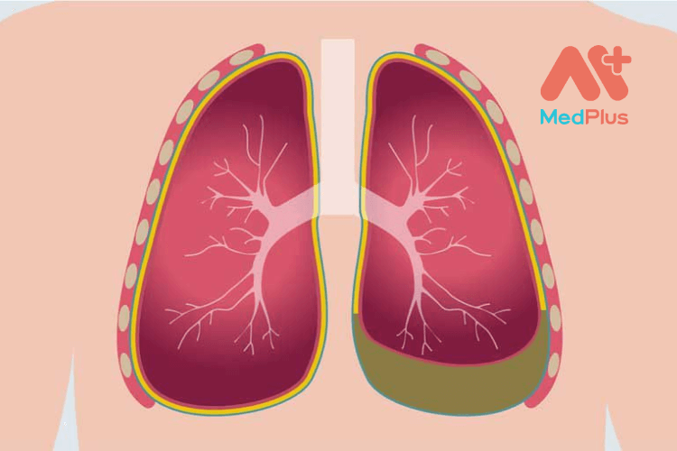 Bạn biết gì về bệnh ung thư màng phổi?