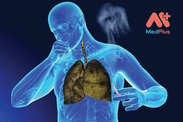Ai nên tầm soát ung thư phổi? Các bước tầm soát ung thư phổi gồm những gì?