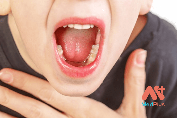 Viêm họng hạt ở lưỡi là bệnh gì?
