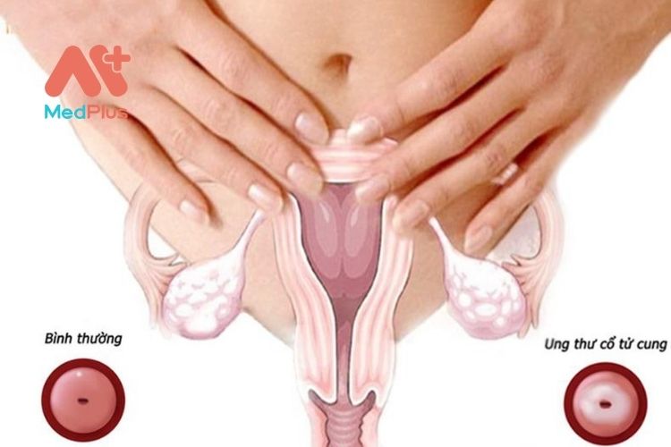 ung thư cổ tử cung là một trong những loại bệnh ung thư phổ biến hàng đầu ở phụ nữ