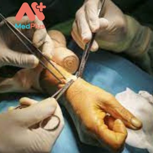 Bệnh viêm bao gân cổ tay