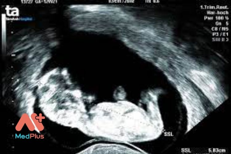 mẹ bầu cần siêu âm tối thiểu 3 lần trong toàn bộ thai kì để theo dõi sự phát triển của thai nhi