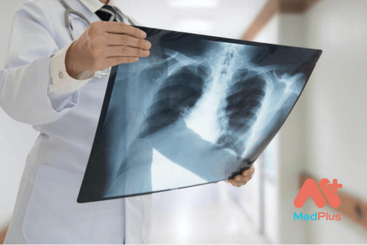 Vôi hoá phổi là bệnh gì? 