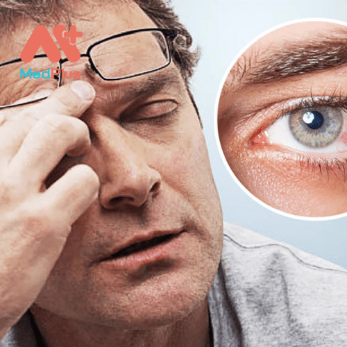 Hội chứng khô mắt là một trong những lý do gây ra kích ứng mắt thường gặp.