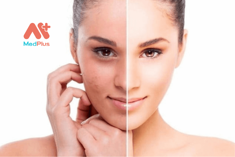 Chứng tăng sắc tố da là gì?