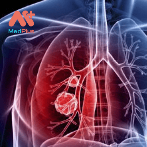 Tăng áp động mạch phổi là một bệnh mãn tính