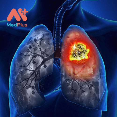 Ung thư phổi di căn bắt đầu ở phổi và lan rộng đến các bộ phận khác của cơ thể