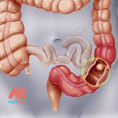Các yếu tố và nguyên nhân nguy cơ ung thư ruột kết là gì? 128 Ung thư ruột kết