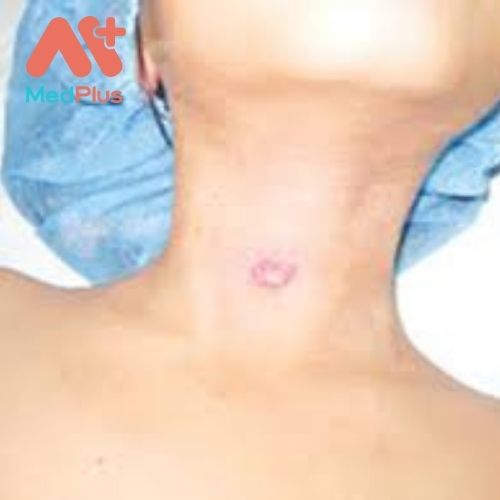 PHẪU THUẬT RÒ KHE MANG LÀ GÌ? 130 Phẫu thuật rò khe mang