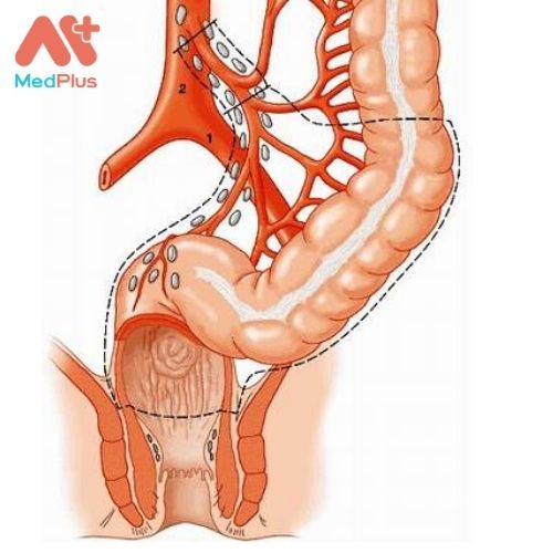 Bệnh nhân viêm loét đại tràng chảy máu có triệu chứng gì? 128 Viêm loét đại tràng