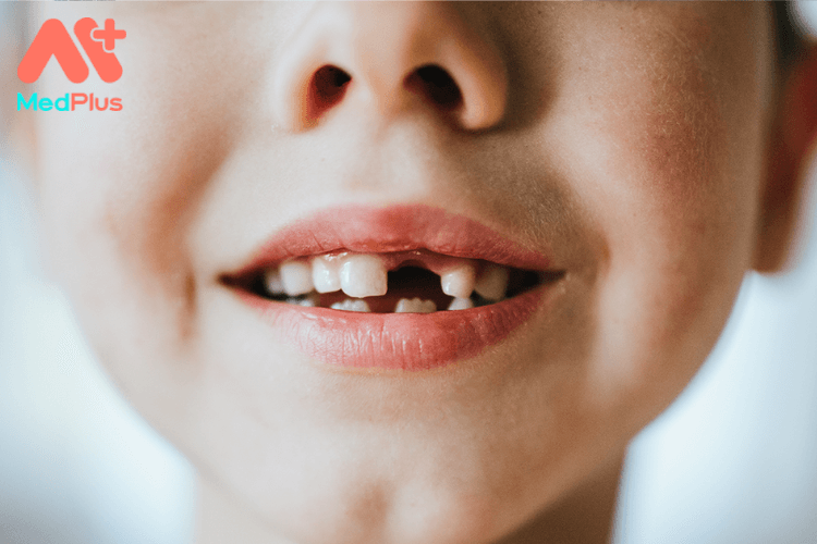 Cách chữa sâu răng cho bé 2 tuổi