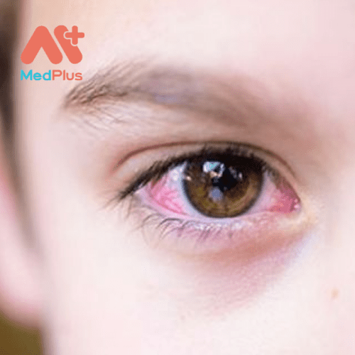 khô mắt gây khó chịu và đặc biệt đau đối với trẻ em