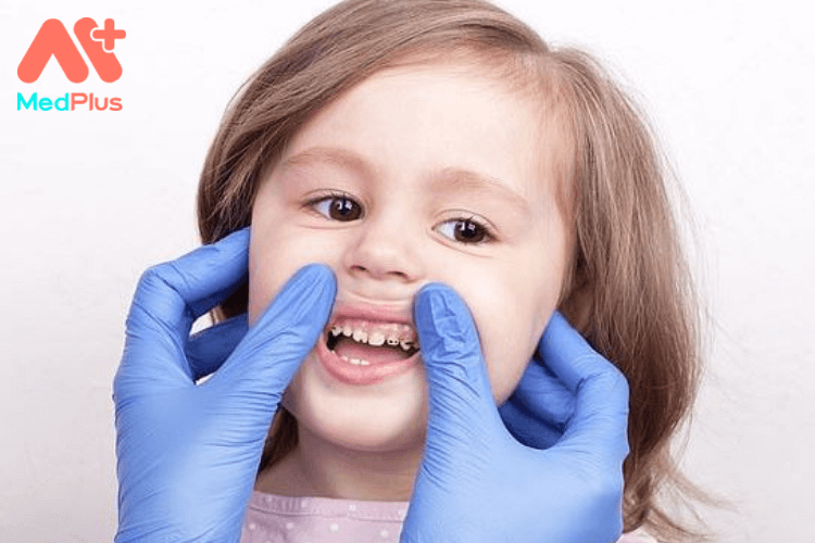 Trẻ bị sún răng sớm phải làm sao?